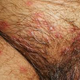Illustration for article titled Tips Cara Mengobati Penyakit Herpes
